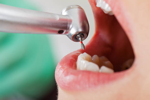 Best Emergency Root Canal Treatment in Bluewell, WV